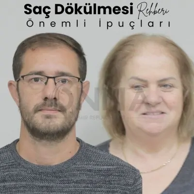 Saç Dökülmesi Rehberi